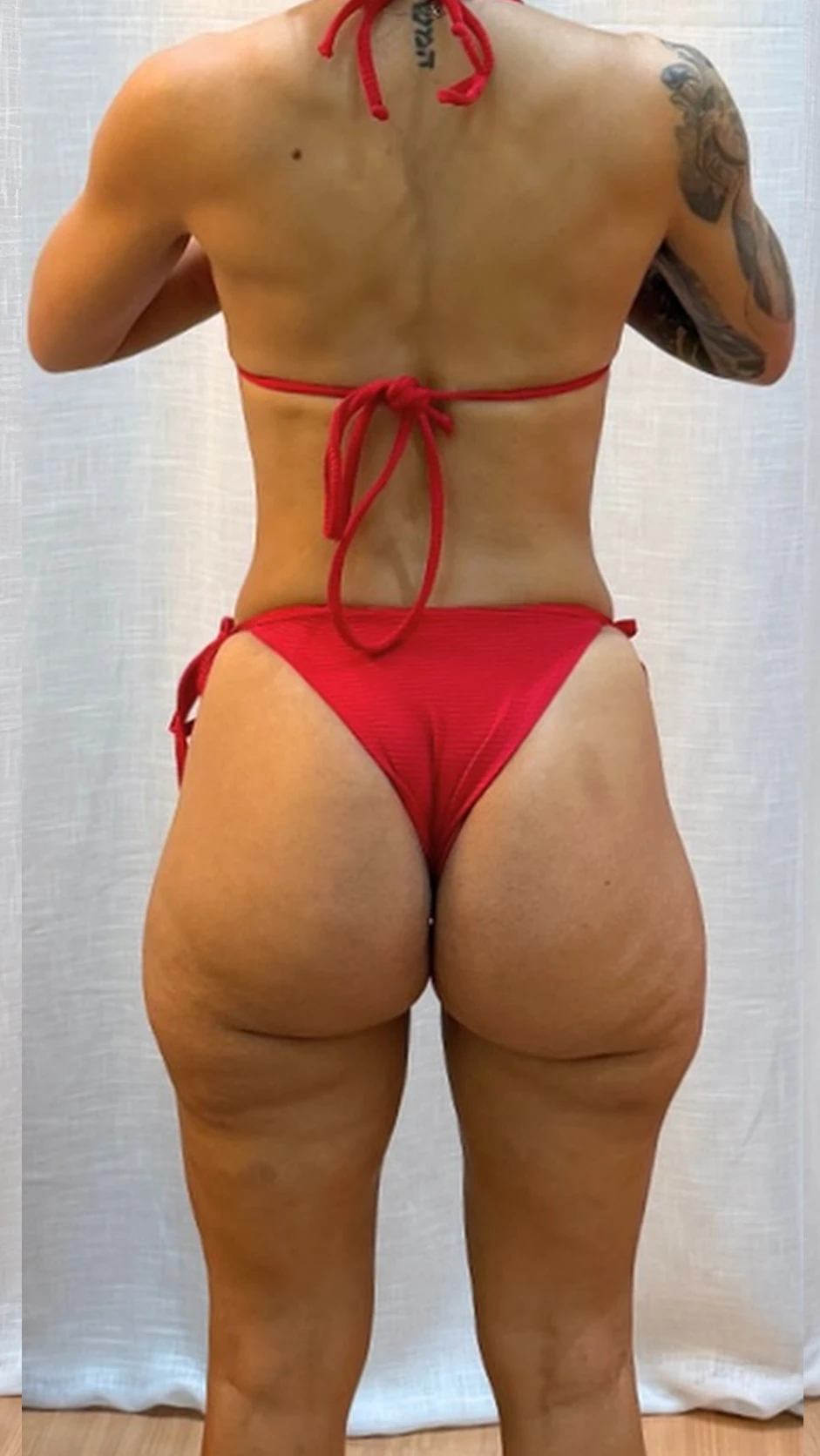Resultado corporal after do tratamento para lipedema