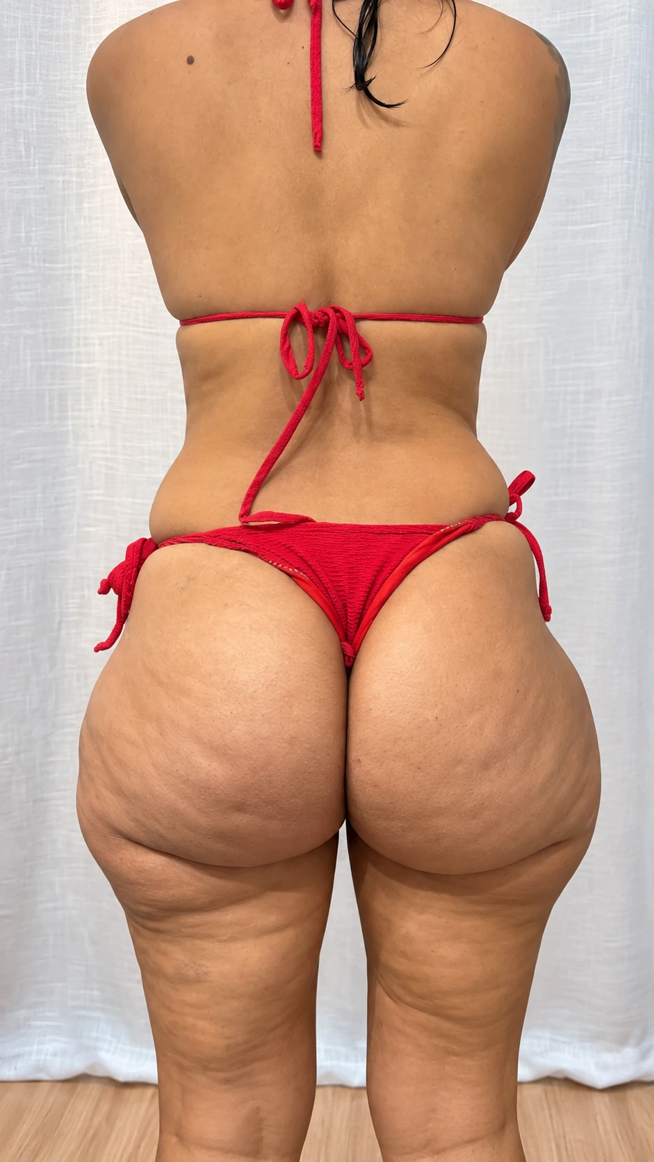 Resultado corporal before do tratamento para lipedema